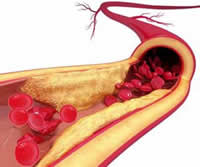Oclusão Arterial Aguda